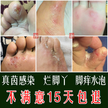 治脚气喷剂去除脚臭脚痒烂脚丫糜烂真菌感染水泡脱皮药特效止痒膏
