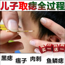 修复脱大凸痣 痣去净膏脸部肉刺瘊灵痣除点痣膏取黑痣水消痦子正品