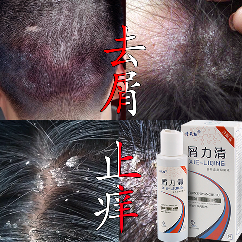 屑力清克去屑止痒洗发水脂溢性头皮藓去头皮屑强效植物精华去屑