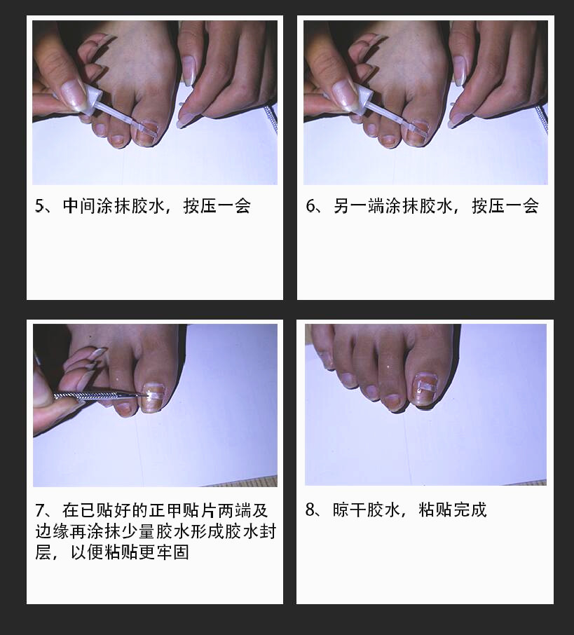 正品正甲贴甲沟嵌甲矫正器脚趾甲矫正贴片专用指甲修脚刀钳套装炎