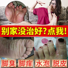 治脚气脚臭脚痒脱皮真菌感染糜烂脚丫型水泡止痒杀菌药膏特效喷剂