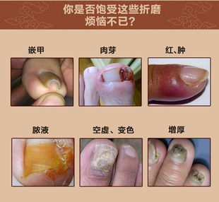 胀疼痛脓液肉芽指甲往肉里钻不拔甲矫正嵌甲器软甲膏 甲沟发红肿