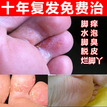 治脚气止痒脱皮糜烂水泡型成人特效喷剂脚臭药膏杀菌净去真菌感染