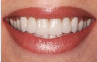 进口口腔牙齿美容冠二氧化锆全瓷牙 全瓷牙贴面瓷 铸瓷上海包安装