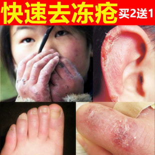 儿童冻疮膏特效止痒防冻防裂脸耳朵脚修复护手霜正品冻伤膏防裂霜