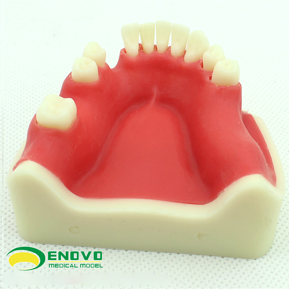 enovo正品口腔种植仿真下颌骨缺失牙模型种植体牙医齿科牙齿模型