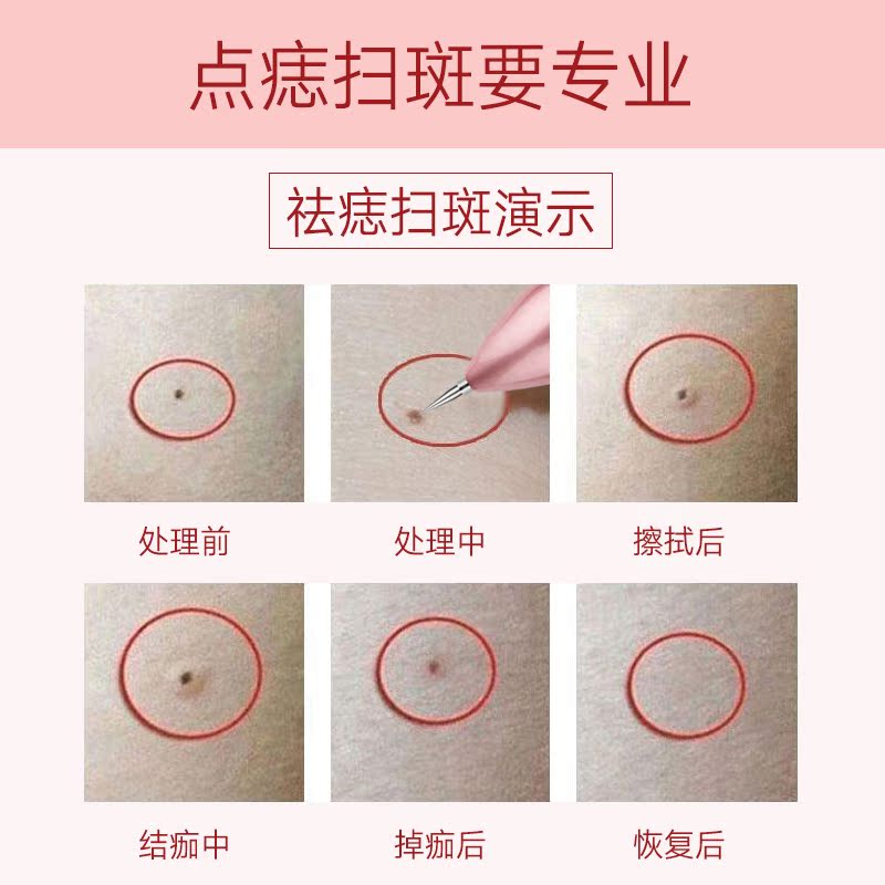 正品扫斑点痣笔德国激光无痕小白家用祛斑机美容院点斑仪器去黑痣