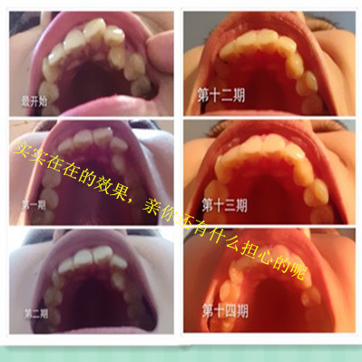 皓美透明隐形美牙齿矫正器 纠正牙缝大 不齐暴牙矫正牙套正畸反弹