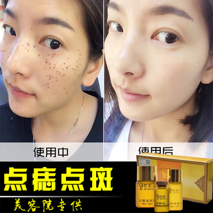 正品美容金水去志痣点志痣点斑药水取痣无痕去黑点痦子黑痣雀斑水