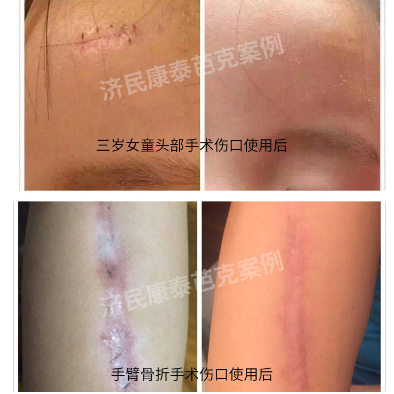 美国芭克疤克kelo-cote巴克祛疤正品手术去疤除疤痕硅