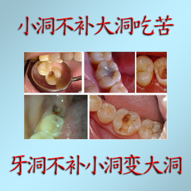 自己补牙材料 补牙洞 补牙缝 粘烤瓷牙补牙齿胶水牙科材料包邮