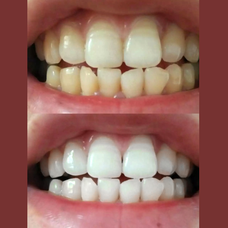 正品[牙齿美白 套装]牙齿美白家庭套装评测 牙齿