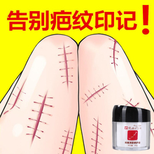草本疤痕灵去除妊娠疤修复膏祛手术凹凸疤痕痘坑伤疤去色素正品