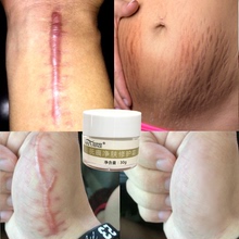 专业去疤痕凹凸疤修复膏手术伤疤烫伤膏除疤膏痘印痘坑产后纹 正品