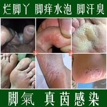 治脚气喷剂去除脚臭止痒脚痒糜烂水泡烂脚丫脱皮药真菌感染特效膏