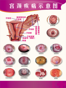 女性生殖器解剖图 医院宣传海报挂图 妇科知识海报宫颈疾病示意图