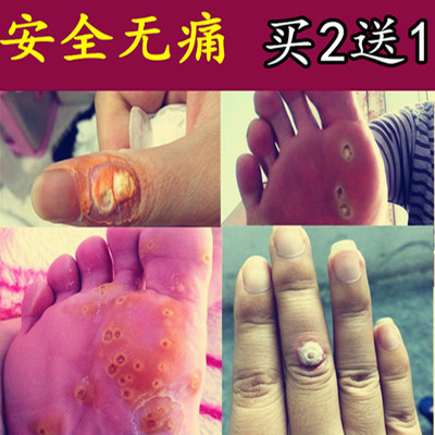 尤猴灵去除鸡眼膏贴乐茧肉刺猴子老茧足部去除死皮脚垫上趾脚茧子