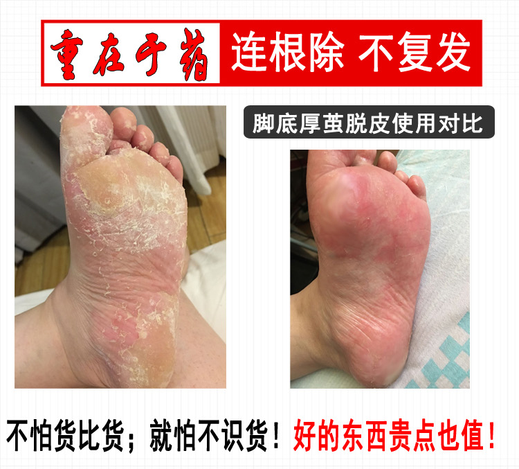 治腳氣噴劑止癢脫皮腳汗腳臭腳癢水泡型爛腳丫去除泡腳粉特效膏王