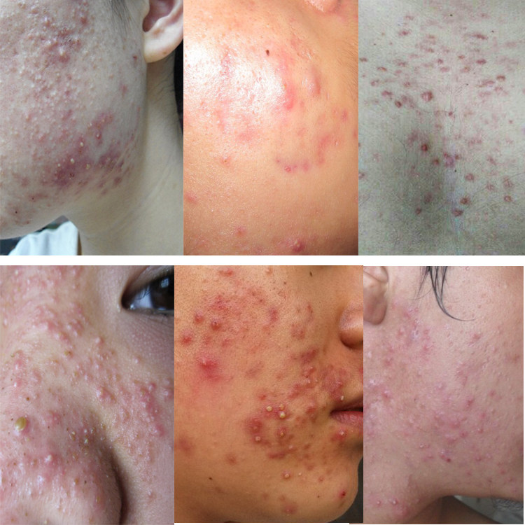 祛痘去粉刺精华青春痘痤疮闭合额头下巴脓包痘印男女祛痘产品